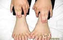 Nguyên nhân nào gây bệnh thừa ngón tay?