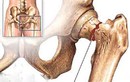Gãy xương ở vùng liên quan đến các tạng