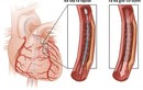 Cách chữa động mạch vành