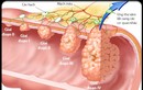 Đối tượng hay “dính” ung thư đại tràng