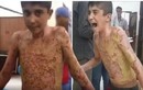 Sát thương kinh hoàng của vũ khí phốt pho Thổ Nhĩ Kỳ 