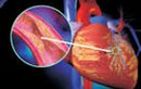 Xơ vữa mạch vành 70% có nên đặt stent?