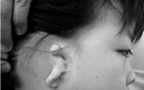 Điều trị cho trẻ sinh ra không có tai