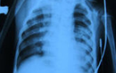 Cứu sống bệnh nhân sởi bằng hệ thống tim phổi ngoài cơ thể