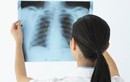 Có cách nào phát hiện sớm ung thư phổi?