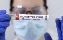 Mỹ ghi nhận trường hợp tử vong đầu tiên do bệnh đậu mùa khỉ