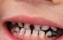 Loạt thói quen khiến trẻ bị sâu răng, cha mẹ nên chú ý sớm