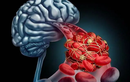 Cảnh báo 6 triệu chứng sớm của nhồi máu não