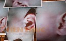 Hà Nội: nghi vấn bé 13 tháng tuổi bị bảo mẫu đánh tím mặt