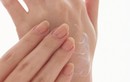 Dễ viêm da vì lạm dụng gel rửa tay diệt khuẩn