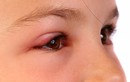 Hình ảnh đau mắt đỏ ở trẻ em: ủ đến phát bệnh