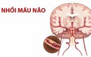 Dấu hiệu nhồi máu não nhẹ, đừng đợi mạch tắc mới khám