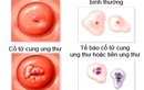 Cách dễ dàng phát hiện ung thư cổ tử cung