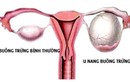 Sự khác biệt giữa ung thư buồng trứng và tử cung