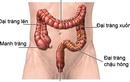 Cách giúp bạn ngừa ung thư đại tràng hiệu quả