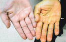 3 dấu hiệu ở bàn tay cho thấy bạn đang có bệnh