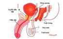 Điều trị ung thư tuyến tiền liệt: lợi bất cập hại