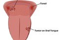 Các giai đoạn của ung thư lưỡi