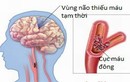 Kết hợp Đông, Tây y điều trị thiểu năng tuần hoàn não 