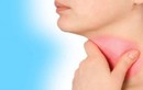 4 dấu hiệu nhận biết sớm ung thư vòm họng