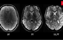 Siêu máy quét MRI cho hình ảnh rõ nét nhất về bộ não người