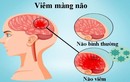 Nhận biết triệu chứng viêm màng não ở trẻ em, chớ dại bỏ qua