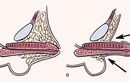 Bác sĩ chia sẻ cách điều trị vùi dương vật bẩm sinh ở trẻ