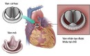 Dùng tiêu sợi huyết cứu bệnh nhân kẹt van tim nhân tạo