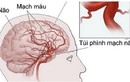 Phình mạch máu não – mối nguy chết người chớ coi thường