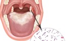Phân biệt bệnh bạch hầu họng với các chứng viêm họng, amidan