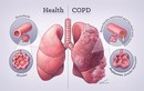 Cách đối phó với bệnh phổi tắc nghẽn hơn 380 triệu người mắc