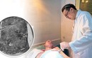 Trẻ 14 tuổi bị nhiễm trùng nặng do điều trị bỏng bằng thuốc nam