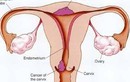 Triệu chứng của UTCTC ở giai đoạn sớm là gì?