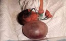 Hoảng hốt khi bé gái sơ sinh “mọc” quả bóng khổng lồ ở mặt