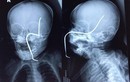 Hà Nội: Tai nạn hi hữu, bé gái 8 tháng bị thanh sắt rỉ xuyên hộp sọ