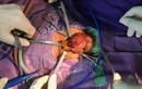 BV Sản Nhi Quảng Ninh phẫu thuật cứu sống bé sơ sinh 16 ngày tuổi 