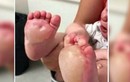 Sự thật rùng rợn về bảo mẫu từ vết phồng rộp trên chân bé 6 tháng tuổi