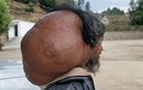 Kinh hãi khối u khổng lồ trên cổ người đàn ông suốt 50 năm