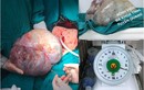 Phẫu thuật thành công khối u buồng trứng khổng lồ nặng 6,2kg