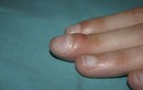 Triệu chứng ở ngón tay cảnh báo ung thư phổi