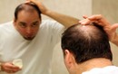 Thuốc trị rụng tóc ảnh hưởng đến bản lĩnh đàn ông