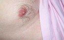 Dấu hiệu cảnh báo sớm ung thư vú ở nam giới