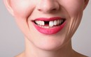 Những thói quen nguy hại khiến răng biến dạng khủng khiếp