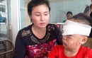 Bé trai 6 tuổi ở Thanh Hóa bị chó nhà cắn rách mặt