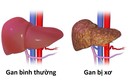 Chuyên gia chỉ điểm 5 kiểu người dễ ung thư gan, bạn có trong số đó?