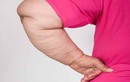 10 dấu hiệu của bệnh béo phì bạn nên biết