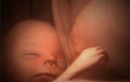 Tan chảy với hình ảnh đáng yêu của các bé song thai, đa thai trong bụng mẹ