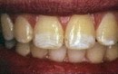 Người cao tuổi và các bệnh răng miệng thường gặp