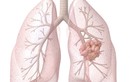 Cận cảnh sự tàn phá khủng khiếp của ung thư phổi