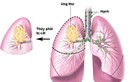 Lý do không thể chữa khỏi bệnh ung thư phổi 